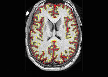 NIH FINDS HOPE FOR MULTIPLE SCLEROSIS PATIENTS