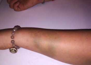 ‘BITING DOG’ ATTACKS 11 YEAR-OLD; AUTHORITIES DO NOTHING, MOTHER SAYS